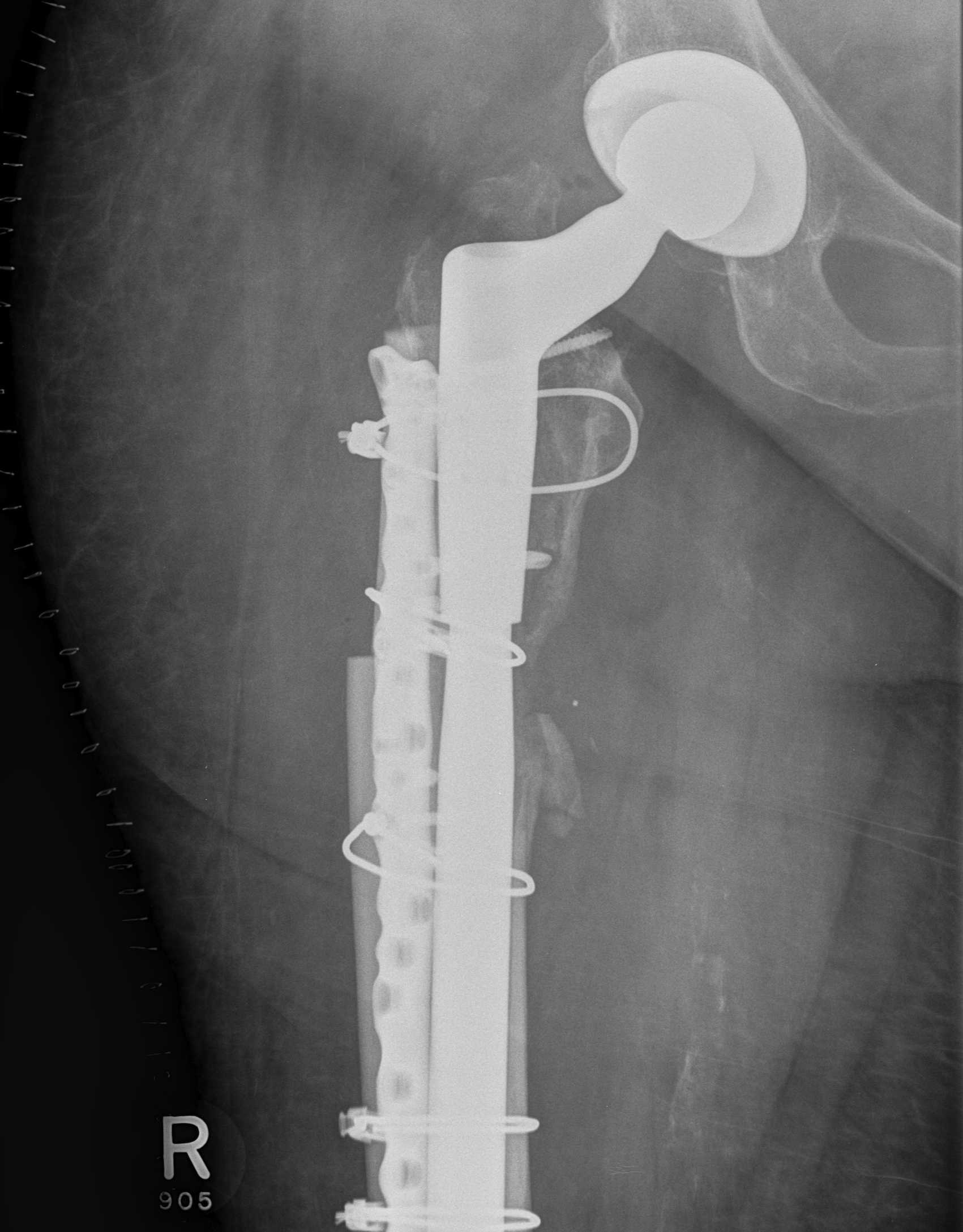 Revision THR Periprosthetic Fracture Uncemented Stem Strut Graft